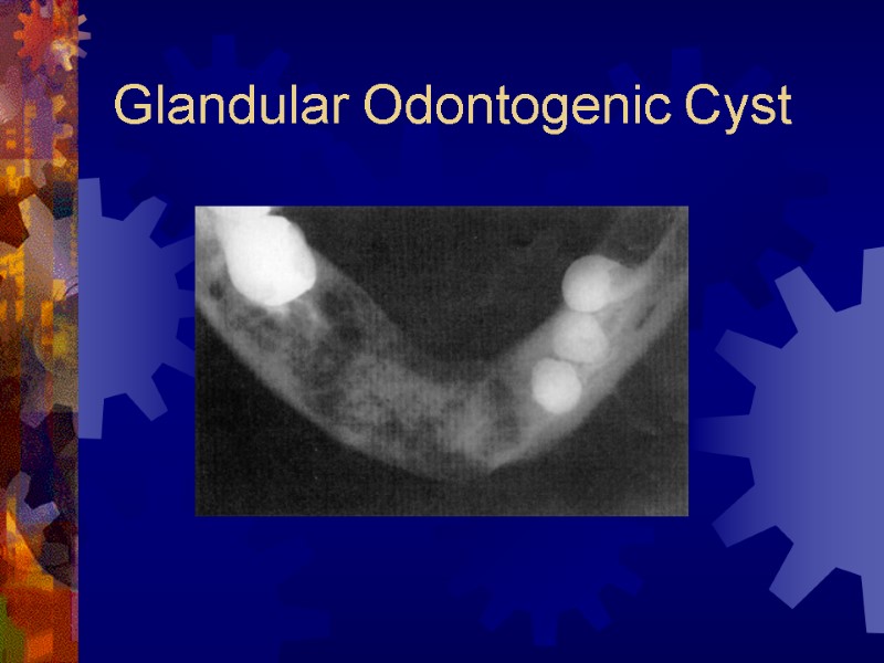 Glandular Odontogenic Cyst